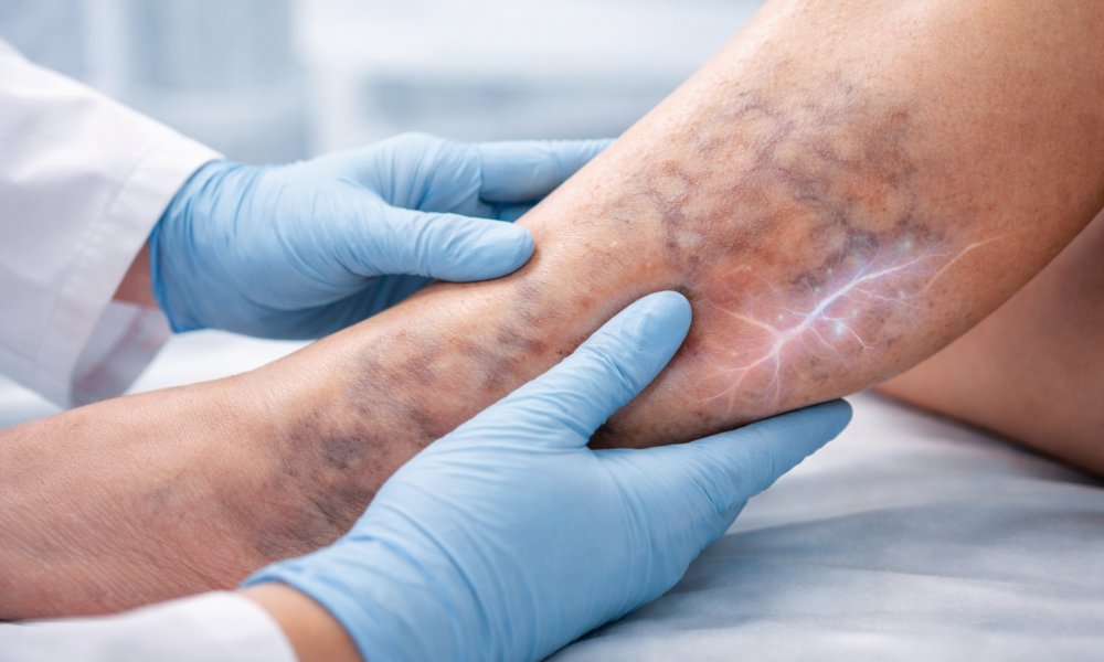 venous leg ulcers causes poor circulation illustration